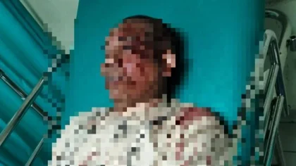 Korban penganiayaan asal Desa Pegayaman, Kecamatan Sukasada, saat menjalani perawatan medis di rumah sakit akibat luka serius yang dideritanya. (Foto: Istimewa)